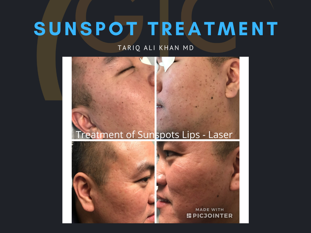 Gentle Care Laser Tustin Before and After picture - Sunspot treatment